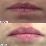 Mini lip enhancement before and after result at PearlMD Toronto
