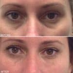 Tear trough before and after result at PearlMD Toronto case 1