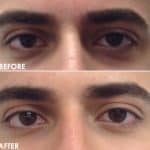 Tear trough before and after result at PearlMD Toronto case 2