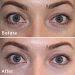 Tear trough before and after result at PearlMD Toronto case 3