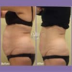 UltraShape before and after body contouring result at PearlMD Toronto case 2