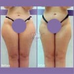 UltraShape before and after body contouring result at PearlMD Toronto case 3