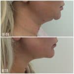 Belkyra result photo at PearlMD Toronto