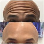 Botox before and after result at PearlMD Toronto case 1