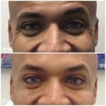 Botox before and after result at PearlMD Toronto case 2