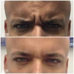 Botox before and after result at PearlMD Toronto case 3