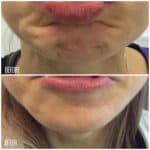 Botox before and after result at PearlMD Toronto case 4