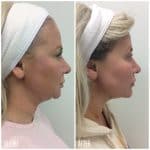 Facial contouring result photo at PearlMD Toronto
