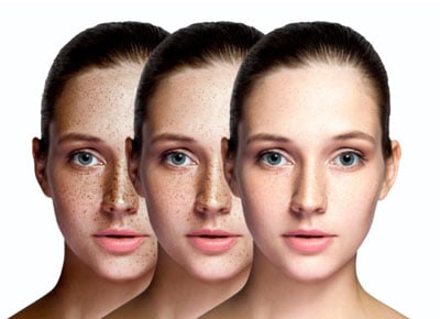 hyperpigmentation fraxel fade freckles