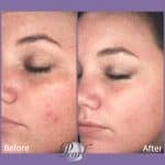 Gloss peel before and after result at PearlMD Toronto