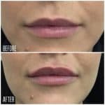 Lip filler result photo at PearlMD Toronto case 1