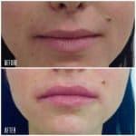 Lip filler result photo at PearlMD Toronto case 2