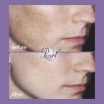 Melanage peel before and after result at PearlMD Toronto