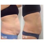 UltraShape and VelaShape body contouring result at PearlMD Toronto