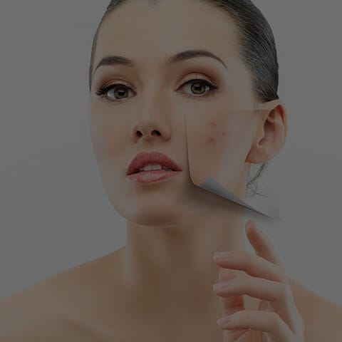Acne Treatment in Toronto