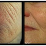 Profound RF before and after result at PearlMD Toronto case 1