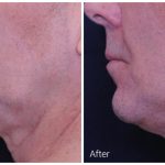 Profound RF before and after result at PearlMD Toronto case 2