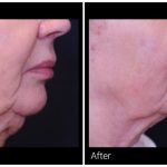 Profound RF before and after result at PearlMD Toronto case 3