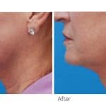 Profound RF before and after result at PearlMD Toronto case 4