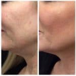 Profound RF treatment result photo at PearlMD Toronto
