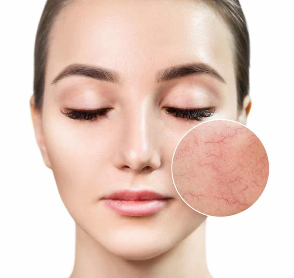 Vascular Laser Therapy in Toronto