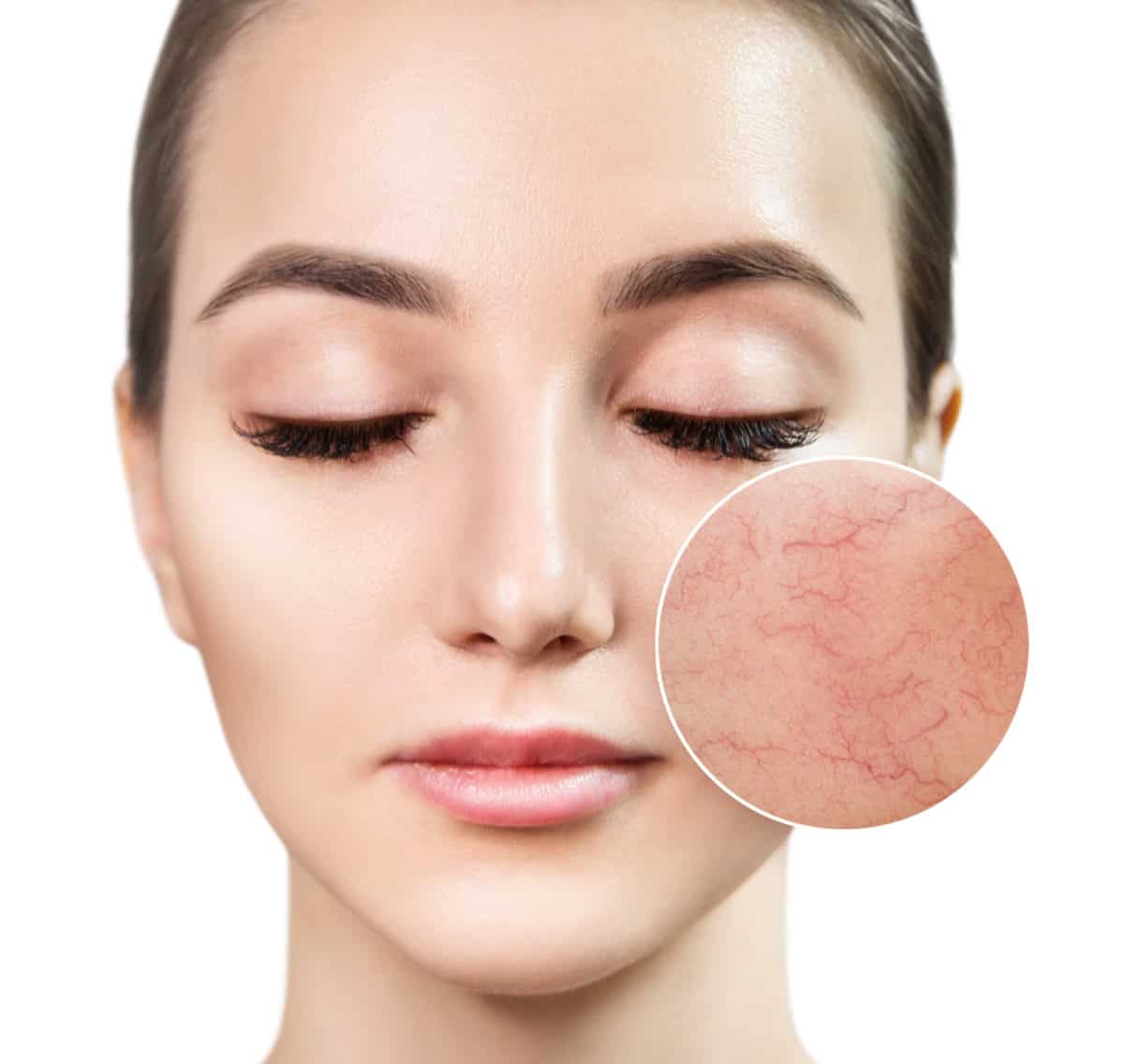 Woman with visible facial redness and rosacea pattern